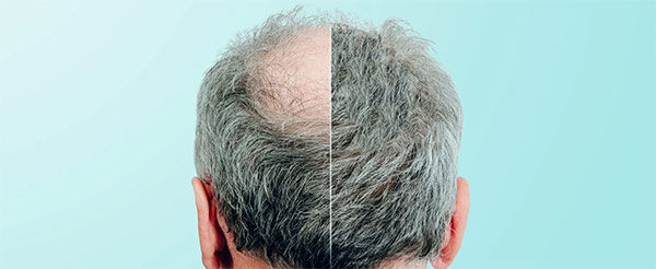 Rogaine as a hair loss treatment