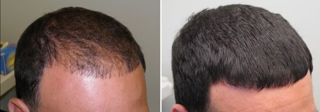 Finasteride bafore after