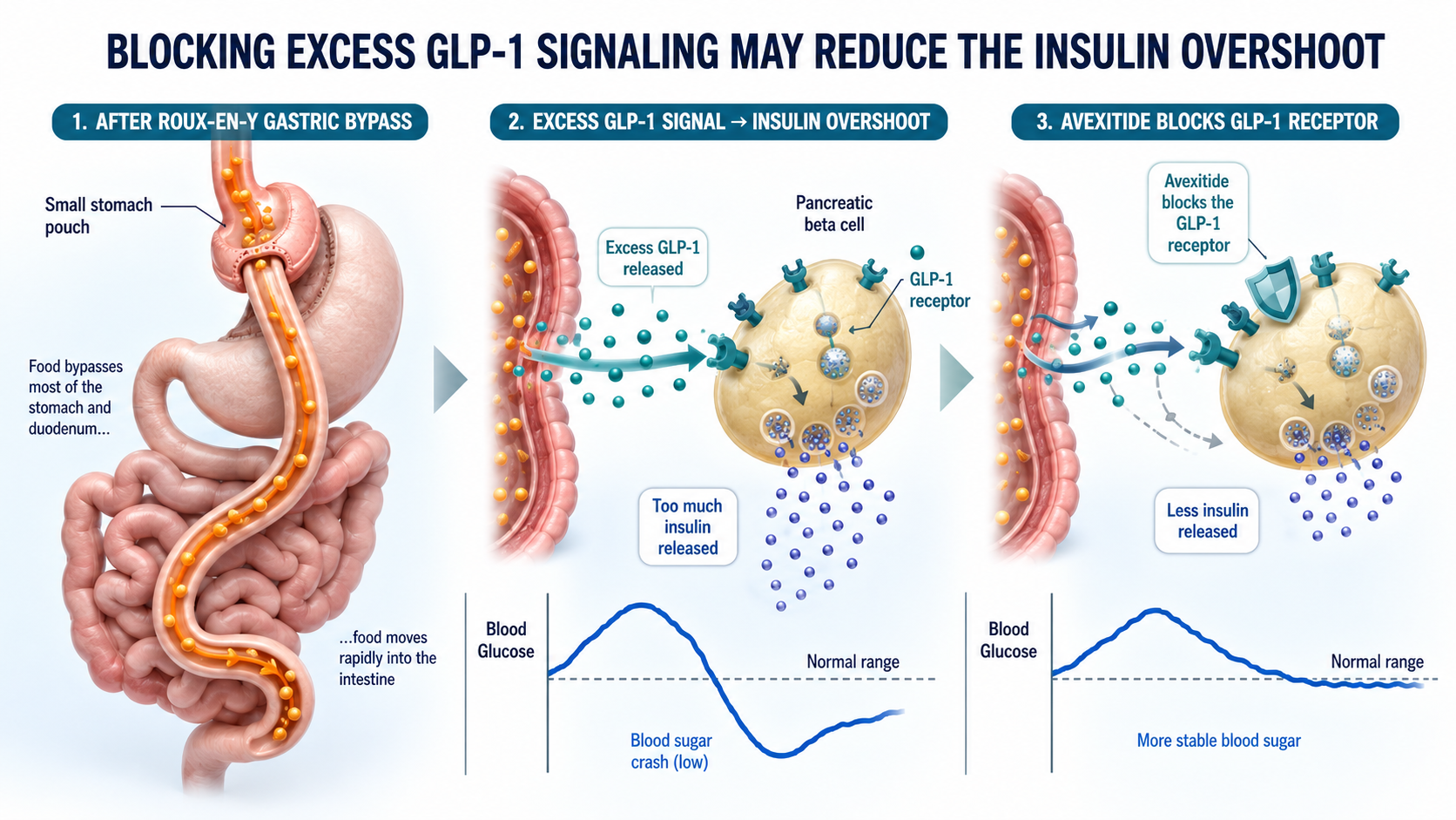 Diagram showing how avexitide blocks excessive GLP-1 signaling and may reduce insulin-driven hypoglycemia after gastric bypass